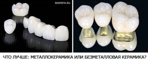 Керамика или металлокерамика – что лучше?